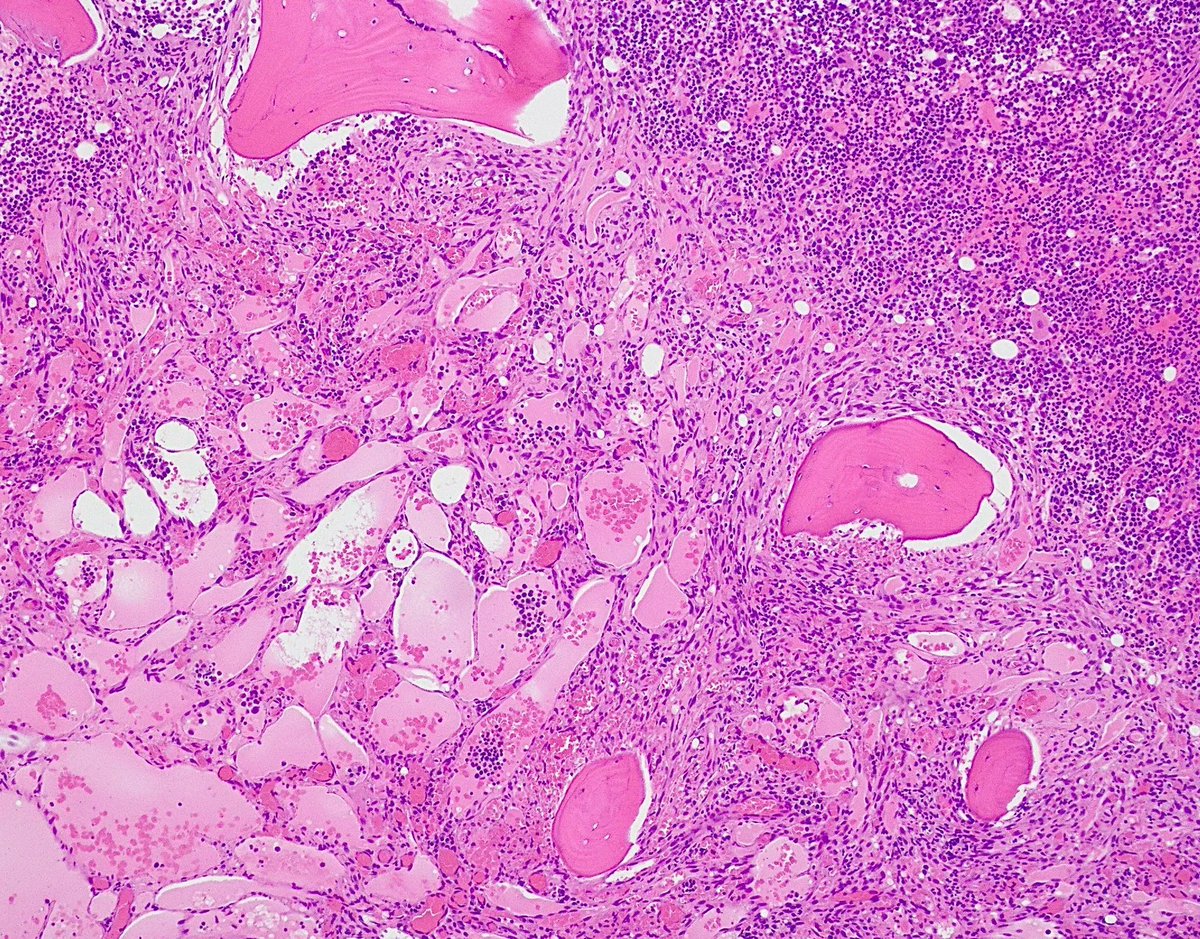 Jerad Gardner, MD on Twitter "RT Gloria_SuraMD Bone marrow biopsy