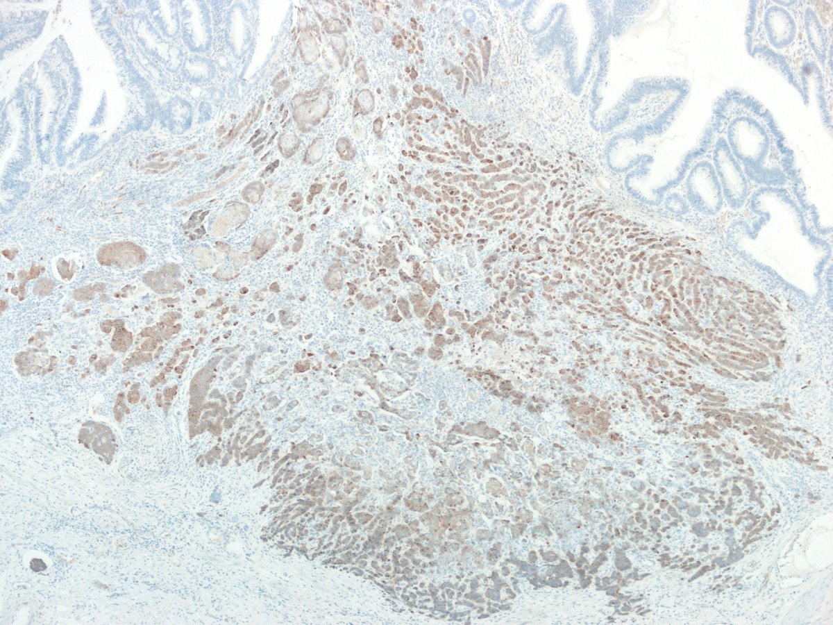 GIJamesMD's tweet image. Synaptophysin, p40, and CDX2

#GIpath #pathology