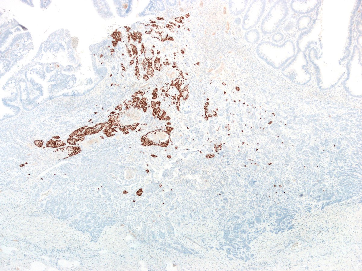 GIJamesMD's tweet image. Synaptophysin, p40, and CDX2

#GIpath #pathology