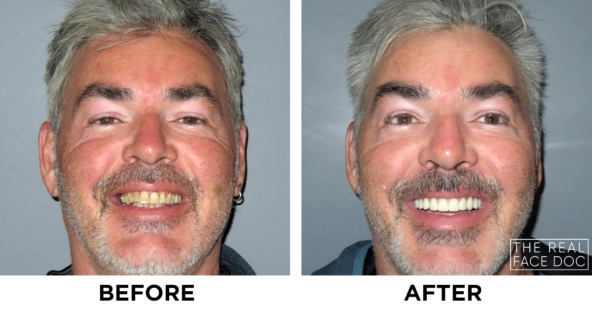therealfacedoc's tweet photo. Kurt is from Georgia. He found New Teeth Now after tons of online research. Kurt needed extensive dental work, and had loose and missing teeth. He ended up having a full set of implant supported teeth placed along with one zygomatic implant for bone loss! https://t.co/gxtQz0CBdI