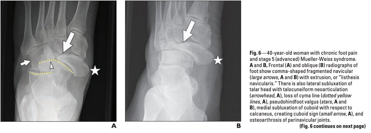 Mueller-Weiss Syndrome (MWS) is a rare condition affecting the navicular bone that was brought into the public eye as the cause of Rafael Nadal's ongoing foot pain. So let's look at it in more detail...🧵 1/6