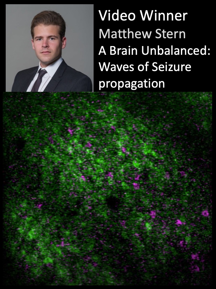 Many congrats to Matthew Stern for winning the ICI-GDBBS Image Competition $100 Video Prize for ' A brain unbalanced: waves of seizure propagation'. Matthew is an MD/PhD grad student in Robert Gross Lab at Emory. @EmoryNeurosurg @EmoryMedicine @emoryici @emoryDSAC