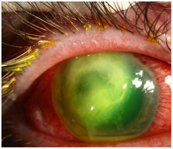 Michael F. Chiang, MD (@neidirector) on Twitter photo There are 68 patients in 16 states with a rare drug-resistant form of P. aeruginosa eye infection.
If you've used EzriCare or Delsam Pharma drops & have signs of eye infection: get care now
3 deaths, 4 enucleations (photo: <a href="/uiowaeye/">UIowa Eye</a>)
<a href="/CDCgov/">CDC</a> <a href="/US_FDA/">U.S. FDA</a>:
cdc.gov/hai/outbreaks/… There are 68 patients in 16 states with a rare drug-resistant form of P. aeruginosa eye infection.
If you've used EzriCare or Delsam Pharma drops & have signs of eye infection: get care now
3 deaths, 4 enucleations (photo: <a href="/uiowaeye/">UIowa Eye</a>)
<a href="/CDCgov/">CDC</a> <a href="/US_FDA/">U.S. FDA</a>:
cdc.gov/hai/outbreaks/…