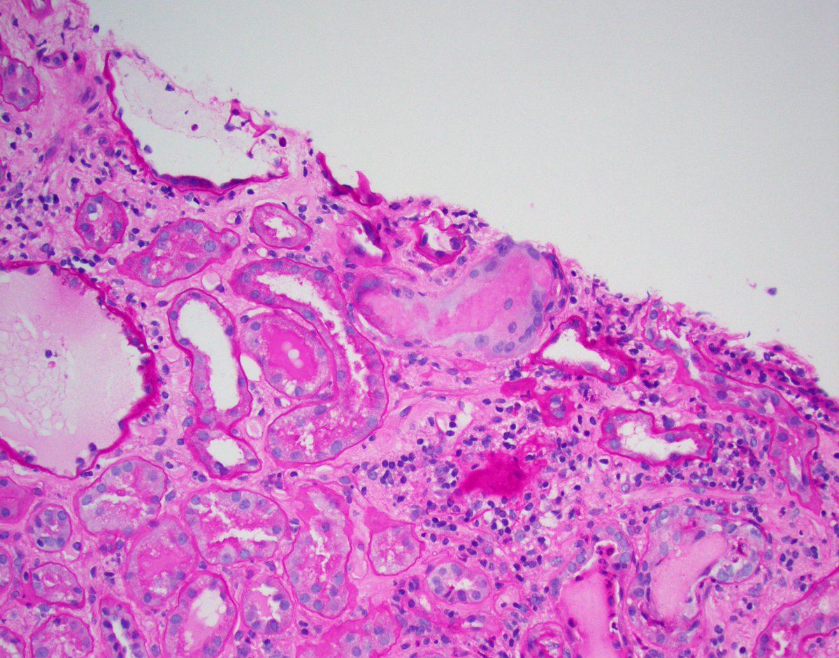 JZRenalPath's tweet photo. A patient with no significant PMHx is found to have acute kidney injury. The biopsy shows the light microscopy findings below. For those of you preparing for your path boards, what's your differential diagnosis? #renalpath #pathtwitter https://t.co/gAP41WvFHn