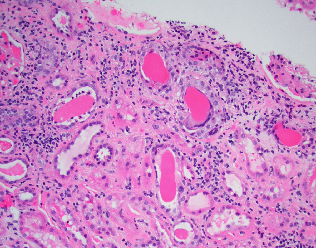 JZRenalPath's tweet photo. A patient with no significant PMHx is found to have acute kidney injury. The biopsy shows the light microscopy findings below. For those of you preparing for your path boards, what's your differential diagnosis? #renalpath #pathtwitter https://t.co/gAP41WvFHn