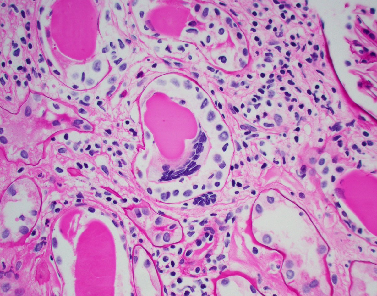 JZRenalPath's tweet photo. A patient with no significant PMHx is found to have acute kidney injury. The biopsy shows the light microscopy findings below. For those of you preparing for your path boards, what's your differential diagnosis? #renalpath #pathtwitter https://t.co/gAP41WvFHn