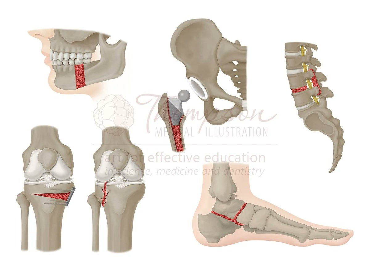 Medillustrates's tweet photo. Illustration by Molly Thompson of various uses for allograft material in bone injuries.
Explore more: https://t.co/aoMAUk9nBY
#allograft #boneinjuries #surgery #orthopedics #biotech #medical #illustration #sciart #medicalillustrator #biomedicalvisuals #science #anatomy https://t.co/IgLavQsv9k
