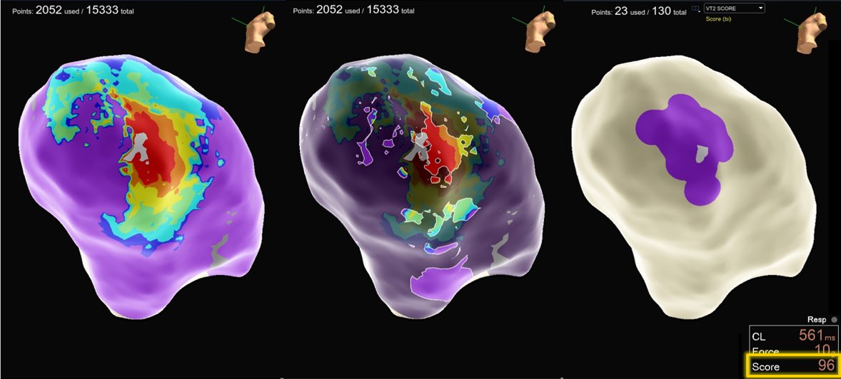 The EP stars aligned for this VT! Clean endo breakout and a 96% pace match. Taking it one step further, our *new* peak frequency emphasis map can help narrow down where to target. After RF, none of the 4 VTs we had seen made a reappearance! #OnlyWithOT #EnSiteX #HDGrid #NearField