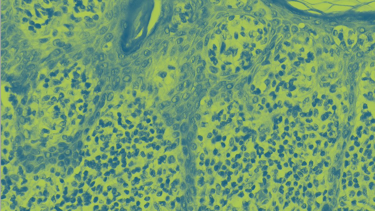 Die Klinik für #Dermatologie und das #Hautkrebszentrum #Lippe laden am 29.03.2023 interessierte Fachkräfte zum Detmolder #DermatoOnkologischen Nachmittag ein: klinikum-lippe.de/veranstaltung/…