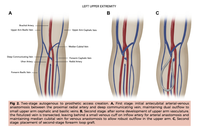 New @JVascSurg paper from the #VESEL lab by @JJFitzgibbon @BrighamVascular @BrighamSurgery @CSPH_BWH describing a staged autogenous to prosthetic #hemodialysis access strategy to maximize forearm options in patients with small vessels authors.elsevier.com/a/1glm92ecZf0l…