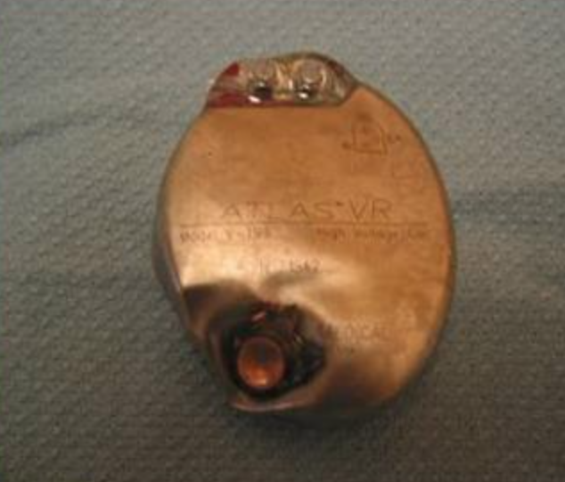 Oren Gottfried, MD on Twitter "A novel way an implantable defibrillator prevents death