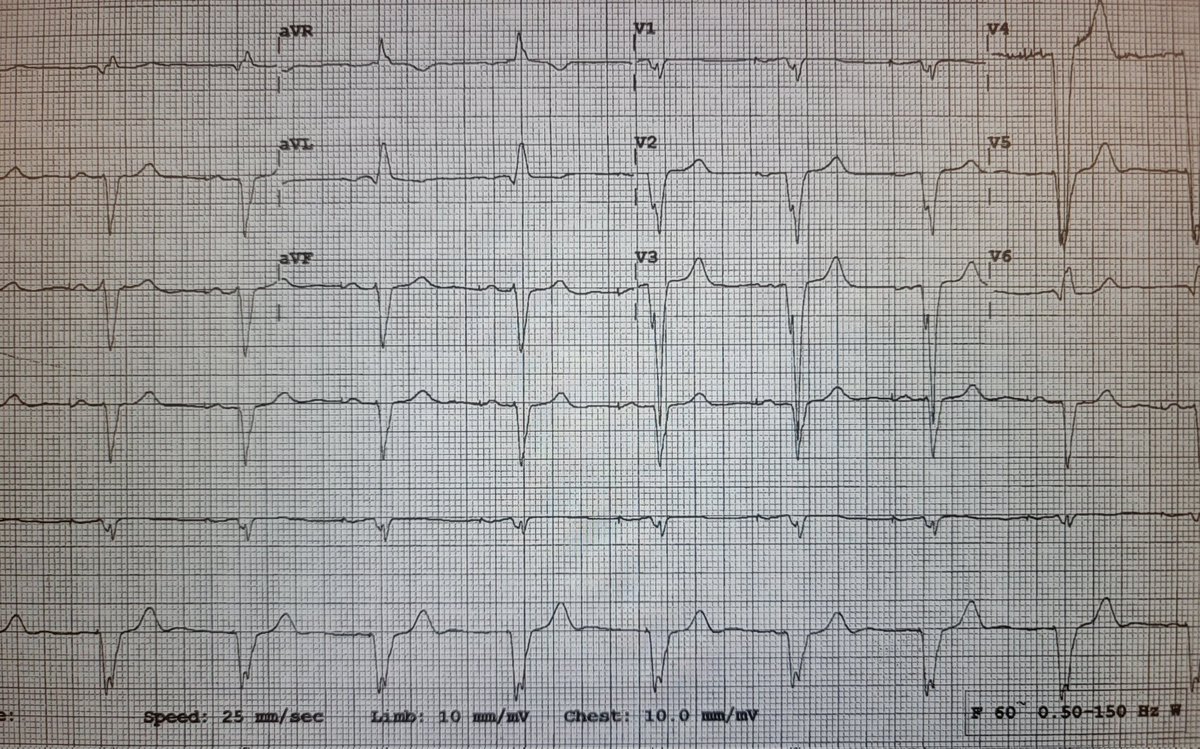 JamesKnellerMD's tweet photo. Pacing induced #cardiomyopathy with #CHF , upgrade to #LBBAP, right sided implant with right to left tunneling for vein obstruction. @MDT_Cardiac #3830 lead #C315 sheath, #Percepta #CRT-P #MRI #SureScan @uazmedphx @BannerHealth @Epeeps_Bot #Epeeps #CardioTwitter #dontdissthehis https://t.co/AOmIMCRCER