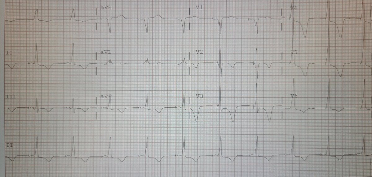 JamesKnellerMD's tweet photo. Pacing induced #cardiomyopathy with #CHF , upgrade to #LBBAP, right sided implant with right to left tunneling for vein obstruction. @MDT_Cardiac #3830 lead #C315 sheath, #Percepta #CRT-P #MRI #SureScan @uazmedphx @BannerHealth @Epeeps_Bot #Epeeps #CardioTwitter #dontdissthehis https://t.co/AOmIMCRCER
