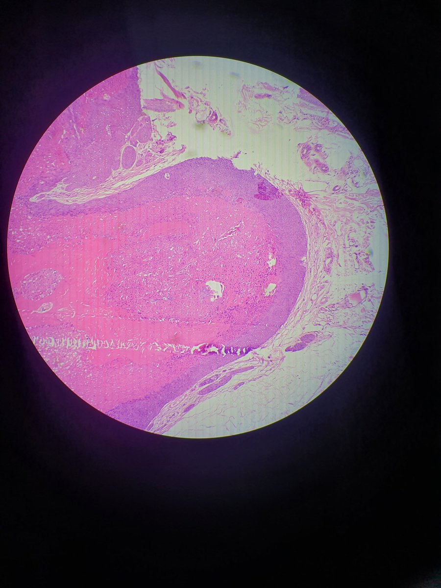 Janoroy24's tweet photo. Biopsy from scalp, give your opinion... https://t.co/VxILktPOpC