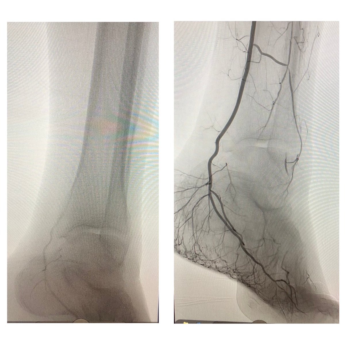 AngioDynamicsCV's tweet photo. Can you believe these results?! These images are from a live case at the TED Conference in Scottsdale, AZ featuring the Auryon Atherectomy System, performed by Dr. Ramaiah using a 1.5mm Auryon catheter. Thank you, Dr. Ramaiah! #ThisChangesEverything #PAD #Auryon https://t.co/lMrGeBAWbc