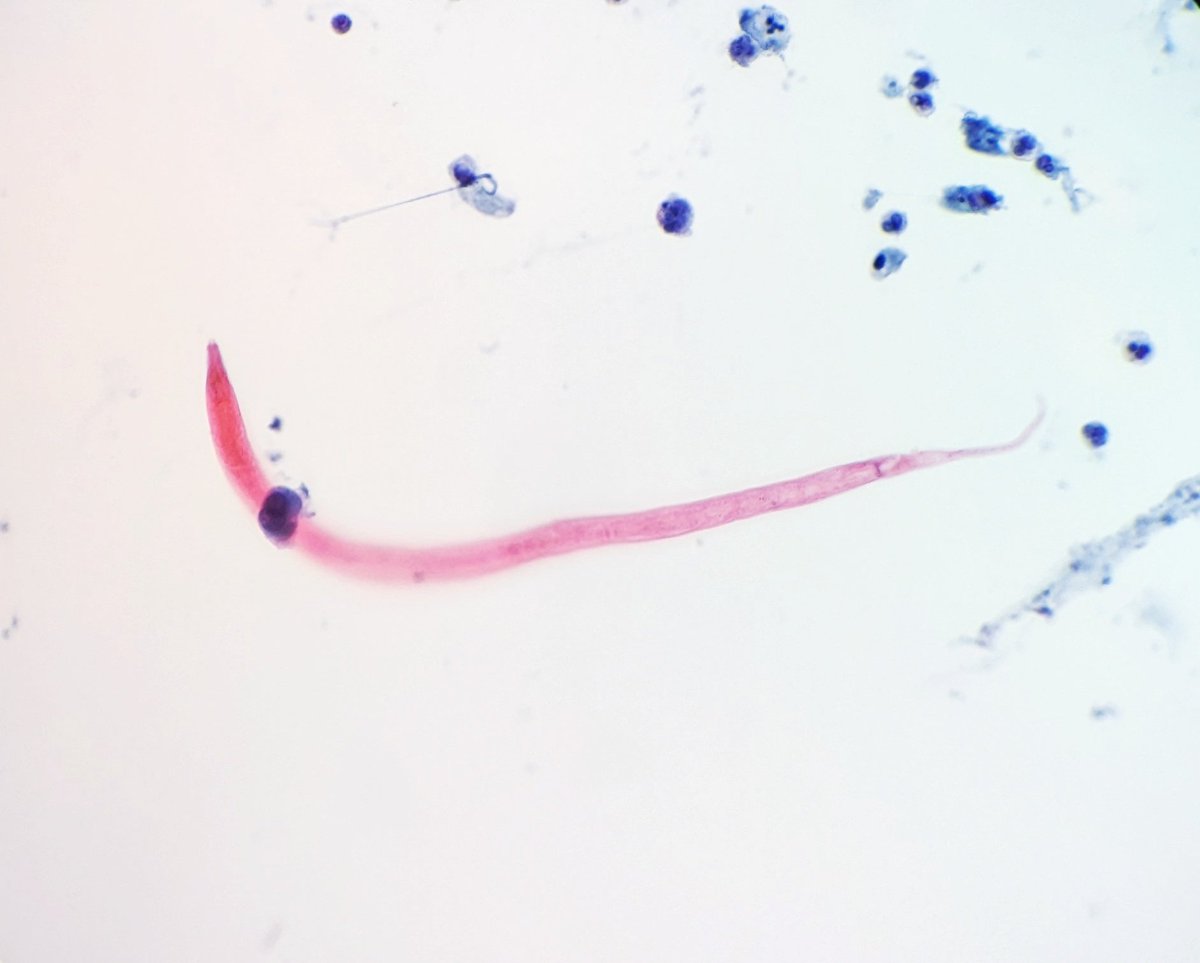 Found in a bronchoalveolar lavage specimen - larval form consistent with Strongyloides stercoralis! 😱🪱

#cytopath #crittersontwitter #pathology