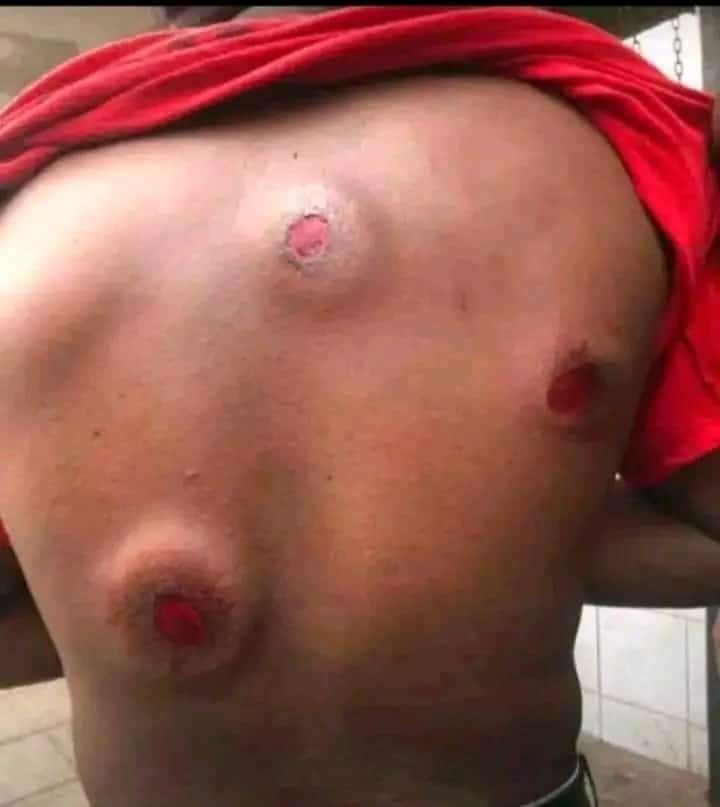 One of the Maseno University student shot with rubber bullets