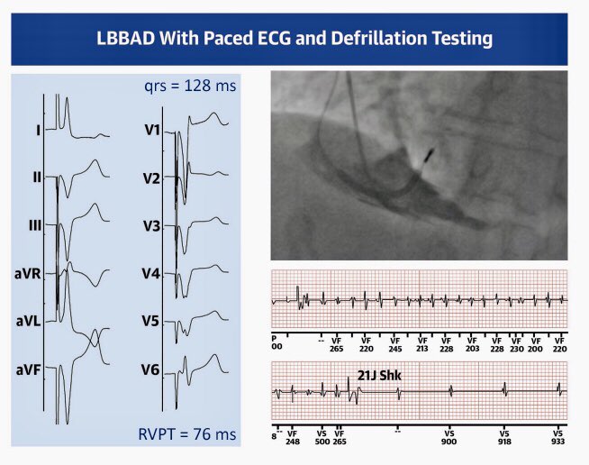 📣 Our new paper is now available in @jaccjournals 

First steps👣 into the new era🌅 of Left Bundle Branch Area ⚡️Defibrillator⚡️?  #LBBAD #LBBAP #dontdisthehis #epeeps 

jacc.org/doi/10.1016/j.…