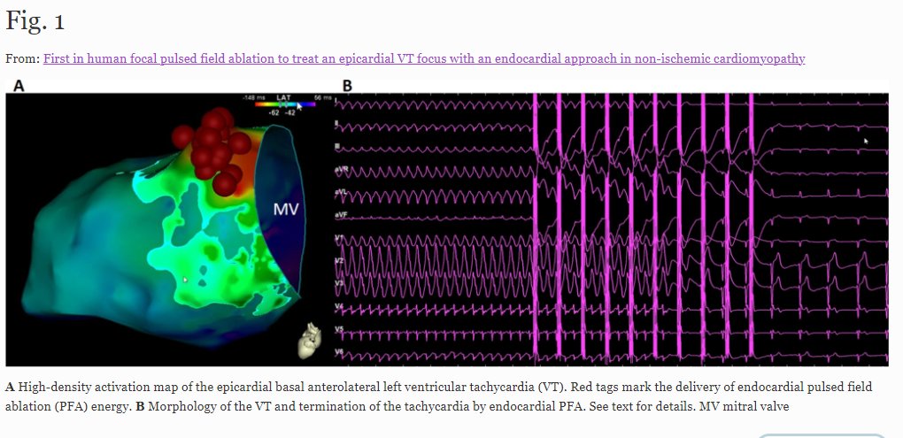 JICE_EP's tweet image. 🚨Latest #FreeRead in @JICE_EP

First-in-Human Focal PFA to Treat an Epicardial VT Focus with an Endocardial Approach in Non-Ischemic Cardiomyopathy

by @WeyandSebastian, Stephanie Löbig &amp;amp; Peter Seizer

📖🧐 #FreeRead: rdcu.be/c8eRh

#EPeeps #AblateVT
