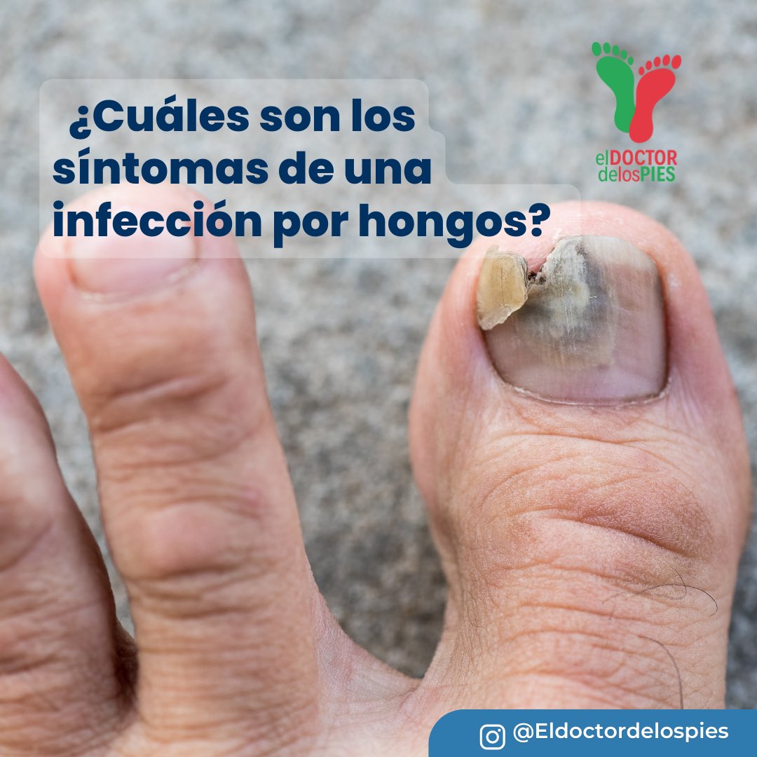 Podiatrasilva's tweet photo. 👉Los síntomas de hongos en las uñas incluyen la presencia de una o varias uñas con las siguientes características:

🔹Engrosamiento.
🔹Decoloración.
🔹Fragilidad, descamación o irregularidad.
🔹Deformidad.
🔹Separación del lecho ungueal.
🔹Mal olor. https://t.co/dWIU6iSUVO