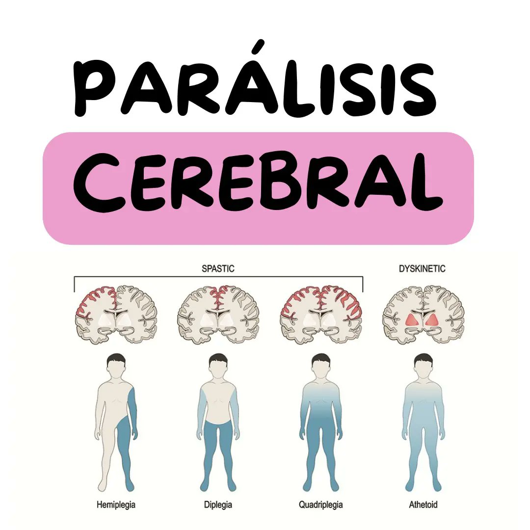 PARÁLISIS CEREBRAL 🧠

➡️ Concepto
➡️ Causas
➡️ Clasificación clinica

#fisioterapia #paralisiscerebral #cerebralpalsy #neuro #fisioterapianeurologica #physiotherapy