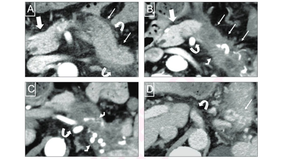 arosenkrantzmd's tweet photo. New @AJR_Radiology Accepted Manuscript:

"Unexplained Acute Distal Pancreatitis: Association With Subsequent Diagnosis of Pancreatic Cancer"

By Drs Bezuidenhout, Tsai, &amp; team @BIDMCRad 

https://t.co/U7rTlS2zmw https://t.co/YpkcuXIq4g