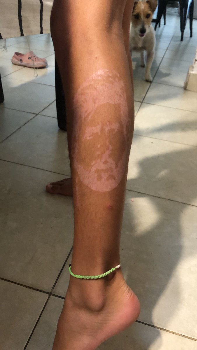 romiflamini's tweet photo. Ella es mi sobrina Renata de 9 años, en sus vacaciones se tatuo con henna la cara de @LeoMessiLM_ y por una reacción alérgica le quedó la cara marcada en su pierna (Ella Chocha) Su sueño es conocerlo en Santiago del Estero❤️❤️ 

RT así le llega 🙏🏻🙏🏻 @rodridepaul @aguerosergiokun https://t.co/Y3tx5GBsGH