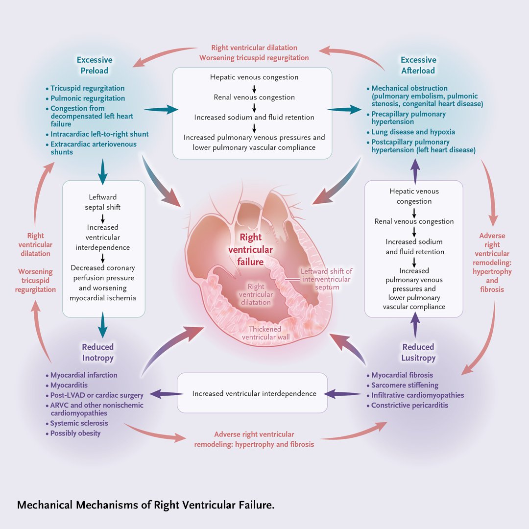 The authors discuss the mechanisms, clinical presentation, and evaluation of right ventricular failure, as well as its management. nej.md/3FCpIFE