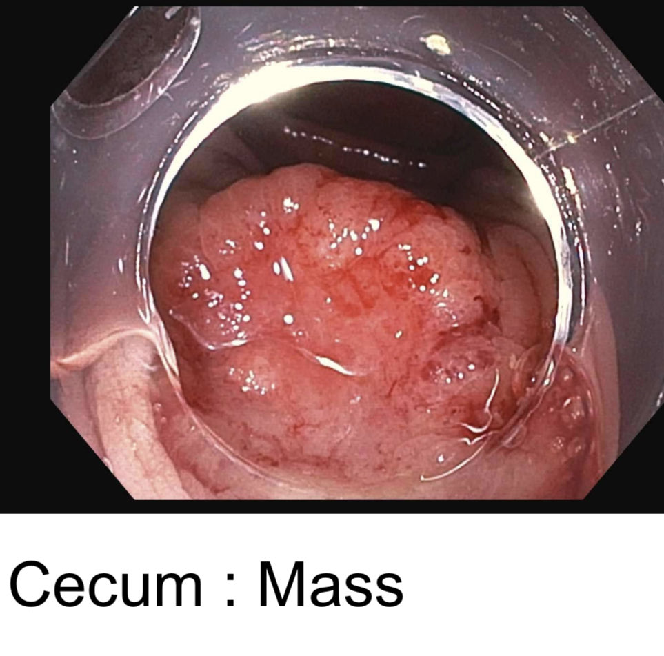 EUSandEndoscopy's tweet photo. Referral from OSH for #ESD of #CecalPolyp but #OpticalBiopsy->loss of nl surface mucosal pattern, depression & NBI #NICE3 c/w deeply invasive cancer confirmed w bx’s & CT peritoneal carcinomatosis @EndoscopyOthman @neilRsharmaMD @DennisYangMD https://t.co/NS3k5R72CL