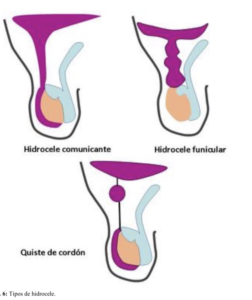 Renzo Quiroz Dioses (@renzoma14) on Twitter photo Quiste de cordón espermático. Debido a la obliteración incompleta del conducto peritoneovaginal (segmento intermedio) <a href="/spuurologia/">Sociedad Peruana de Urología</a> <a href="/HospitalUnanue/">Hospital Nacional Hipólito Unanue</a> <a href="/UroStuds/">Urology for Students</a> #Urology #Urologist #UroSoMe #UrologyTweets Quiste de cordón espermático. Debido a la obliteración incompleta del conducto peritoneovaginal (segmento intermedio) <a href="/spuurologia/">Sociedad Peruana de Urología</a> <a href="/HospitalUnanue/">Hospital Nacional Hipólito Unanue</a> <a href="/UroStuds/">Urology for Students</a> #Urology #Urologist #UroSoMe #UrologyTweets