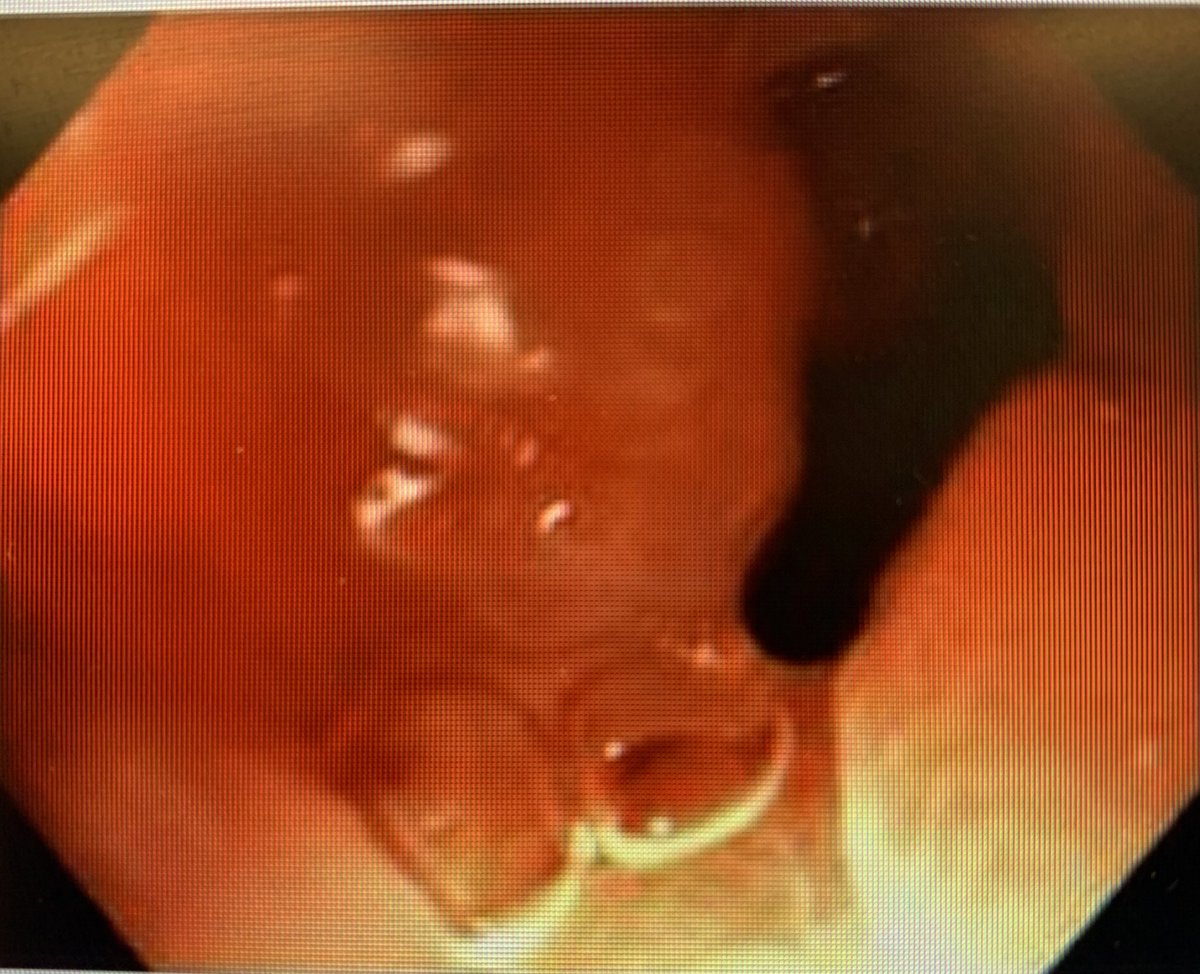 Mohannad Abousaleh, MD (@mo_abousaleh) on Twitter photo AXIOS to treat a short (1 cm) rectosigmoid malignant stricture. No need for diversion. Eventually underwent a left hemicolectomy 4 weeks later.
<a href="/ChahalPrabhleen/">Prabhleen Chahal MD,MASGE,FACG</a> <a href="/JPAchkarMD/">Jean-Paul Achkar</a> <a href="/RobertoSimonsMD/">Roberto Simons-Linares, MD</a>
<a href="/hurongastro/">Huron Gastro</a> AXIOS to treat a short (1 cm) rectosigmoid malignant stricture. No need for diversion. Eventually underwent a left hemicolectomy 4 weeks later.
<a href="/ChahalPrabhleen/">Prabhleen Chahal MD,MASGE,FACG</a> <a href="/JPAchkarMD/">Jean-Paul Achkar</a> <a href="/RobertoSimonsMD/">Roberto Simons-Linares, MD</a>
<a href="/hurongastro/">Huron Gastro</a>