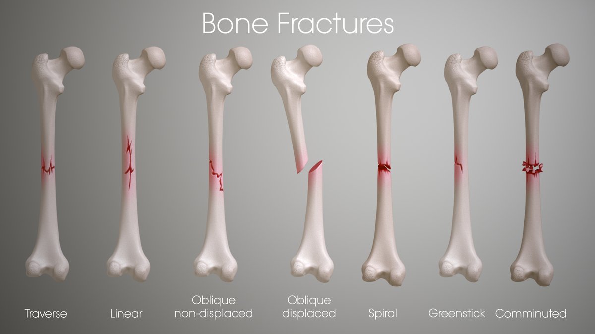 ortho_clinres's tweet image. Bone fractures occur due to the high impact of force, such as falls or accidents, due to certain medical conditions such as osteoporosis or some cancers. 
Different types of fractures are described in the image.

#osteoporosis #bonefractures #bonesurgery #bonehealth #orthopaedics