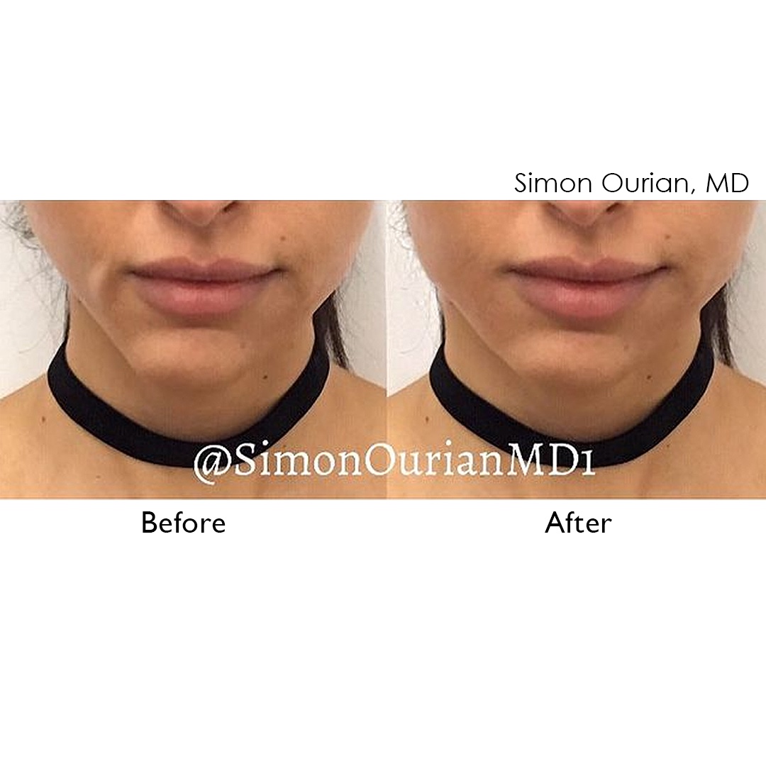simonourianmd's tweet photo. Non-Surgical Correction of Facial Asymmetry
#jawcorrection #jaw #face #simonourian #epione #epionebeverlyhills #beautydoctor #nonsurgical https://t.co/5jRpCvhNT6