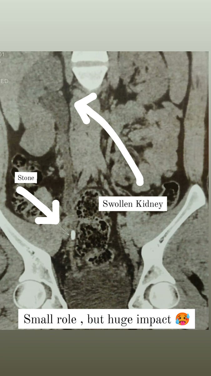 #SmallRoleHugeImpact #Trending 
#awarenessdrive
#urology #saynotostones

Small role but huge  NEGATIVE impact.. #SmallRoleHugeImpact

Sometimes even small sized stone can cause severe damage to kidney.