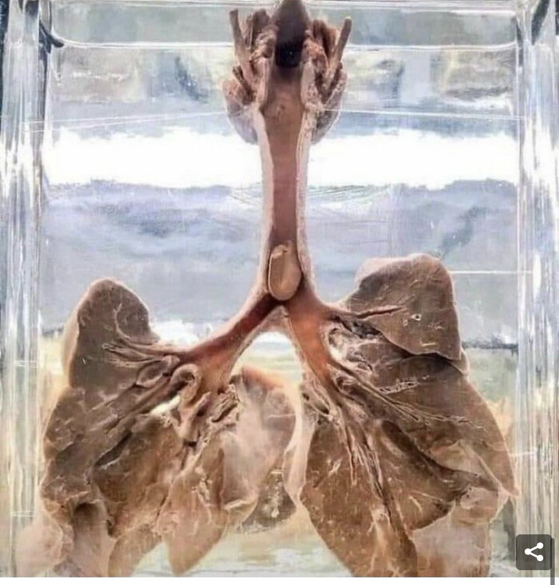 This is a picture of the lungsof a child who died of suffocation. This is a peanut. Peanuts are usually the size of a child's airway under 4-5years.
Avoid giving children peanuts, peas, nuts, small dried fruits, candies and popcorn. 

Death can't be undone, only prevented.