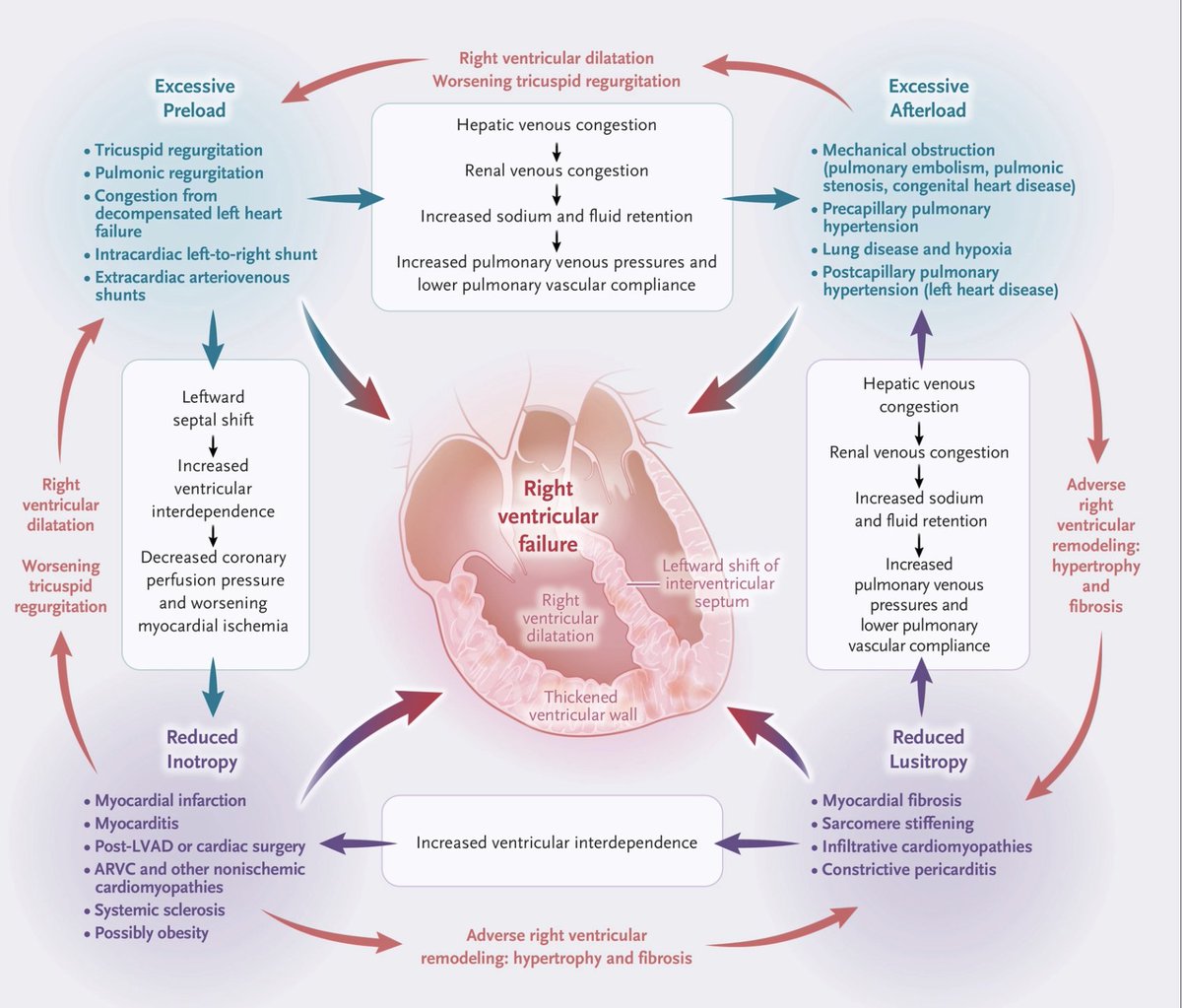 <a href="/NEJM/">NEJM</a> review article: Right Ventricular Failure
🫀pathophysiology
🫀diagnosis &amp; evaluation
🫀mechanisms of failure
🫀treatments
🫀RV focussed/inclusive clinical trials

nejm.org/doi/full/10.10… 

#heartfailure <a href="/RyanTedfordMD/">Ryan J Tedford MD</a> @Brian_Houston12