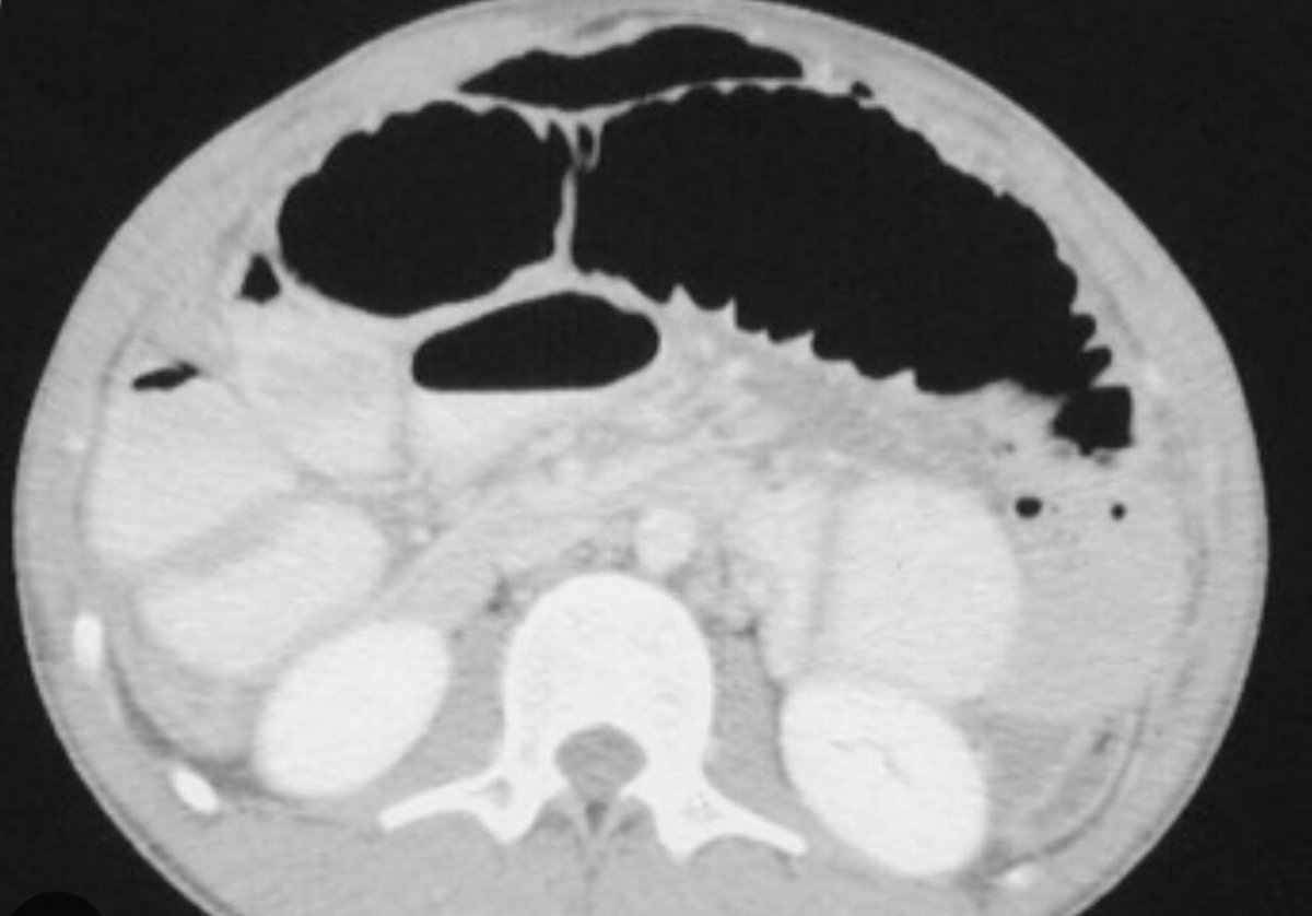ScottRSteeleMD's tweet photo. #quickcase. A young male sustains a gunshot wound to left buttock with exit out right thigh. Flex sig with min blood and no identifiable wound. VS P105 BP 120/60s. Abdomen mild distension, no peritonitis. CT as shown. What now? https://t.co/EXhRXLWnBL