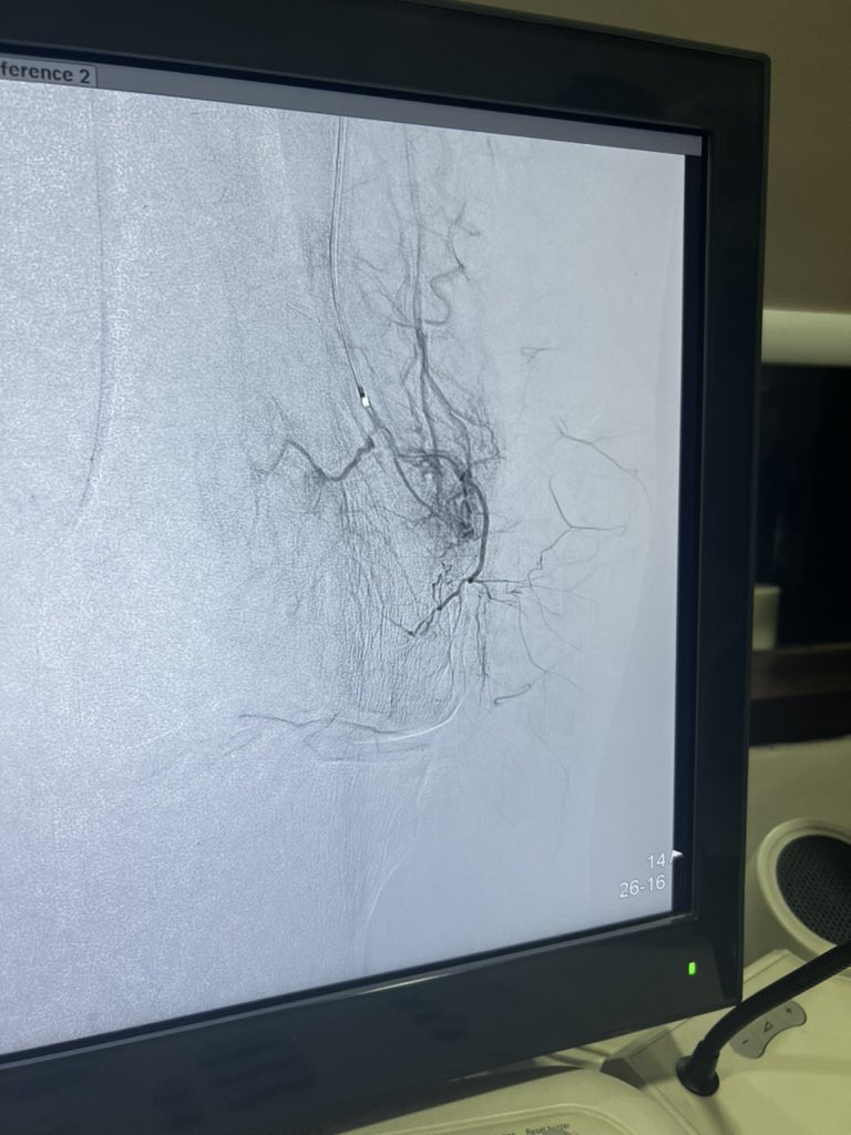 BasavaRaj (@basavaraj_ir) on Twitter photo Genicular artery embolisation - for osteoarthritis knee pain. Thank you <a href="/SandeepBaglaMD/">Sandeep Bagla MD</a> <a href="/LCasadaban/">Leigh Casadaban, MD</a>  for the wonderful articles on GAE. Genicular artery embolisation - for osteoarthritis knee pain. Thank you <a href="/SandeepBaglaMD/">Sandeep Bagla MD</a> <a href="/LCasadaban/">Leigh Casadaban, MD</a>  for the wonderful articles on GAE.