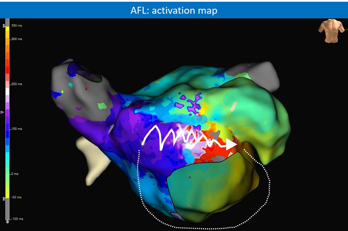 We keep on learning with EnsiteX omnipolar NEAR FIELD. Perimitral reentry in a non-ablated case. Big spontaneous LA anterior scar, yet with HIGH frequency EGM corridor (&gt;350Hz)... right at the isthmus. Just placing abl catheter there terminated it... see👇🧵 #EPeeps