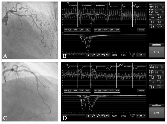 Giuseppe Biondi-Zoccai (@gbiondizoccai) on Twitter photo Clinical implications of coronary microvascular dysfunction in patients with non-obstructive coronary artery disease and role of the thermodilution method, by Benedetti et al
minervamedica.it/en/journals/mi…
#MinervaCardiologyAngiology
<a href="/AgostoniPF/">Pierfrancesco Agostoni</a> Clinical implications of coronary microvascular dysfunction in patients with non-obstructive coronary artery disease and role of the thermodilution method, by Benedetti et al
minervamedica.it/en/journals/mi…
#MinervaCardiologyAngiology
<a href="/AgostoniPF/">Pierfrancesco Agostoni</a>