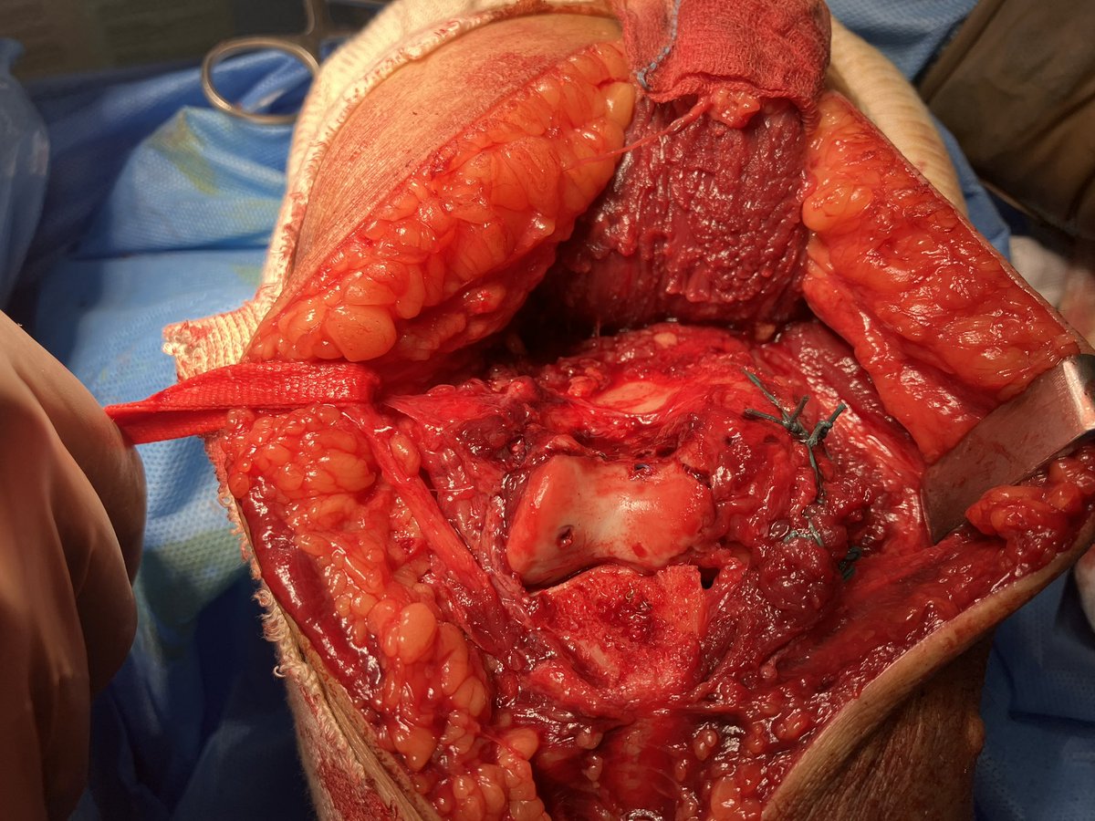 Gaining access in an anterior shear fracture of distal humerus. After an olecranon osteotomy, the LUCL was divided at its humeral origin for visualising the capitellum and trochlea. The ligament was sutured back after osteosynthesis. #handsurgery