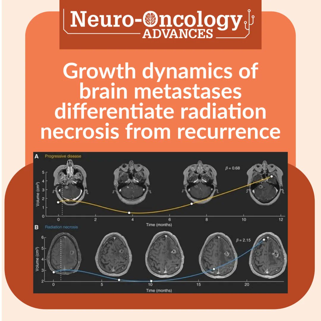 Can growth law exponents obtained from sequential longitudinal #MagneticResonance images after FSRT/SRS be used as a complementary tool in the differential diagnosis between RN and PD?

buff.ly/3ZZYhgT

#NeuroOncology #BrainMetastases #oncology #radiosurgery