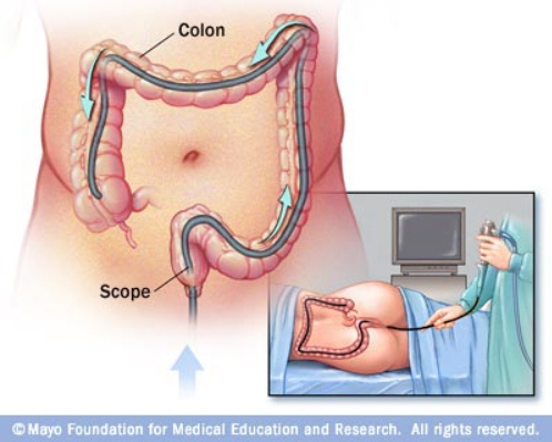 Reduce your risk of #ColonCancer: Eat a variety of fruits, veggies and whole grains; drink alcohol in moderation; stop smoking; exercise; and maintain a healthy weight. mayocl.in/3lDCLzO #ColorectalCancer #ColorectalCancerAwarenessMonth