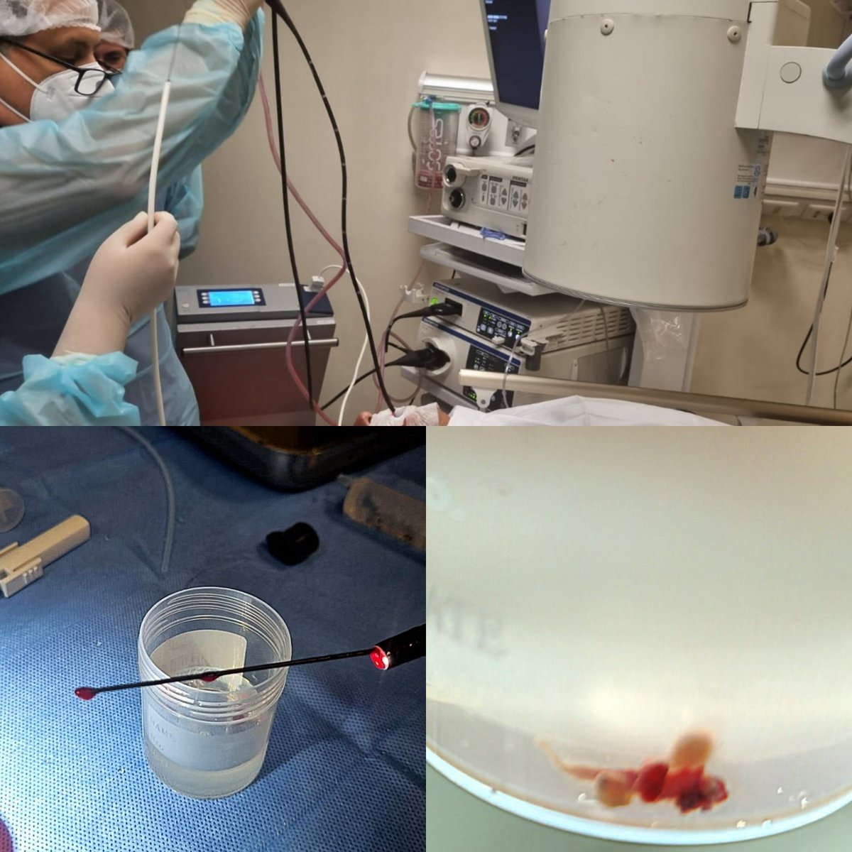 Cryobiopsy for interstitial lung diseases. Cryoprobe 1.1mm. conscious sedation.
#interventionalpulmonology