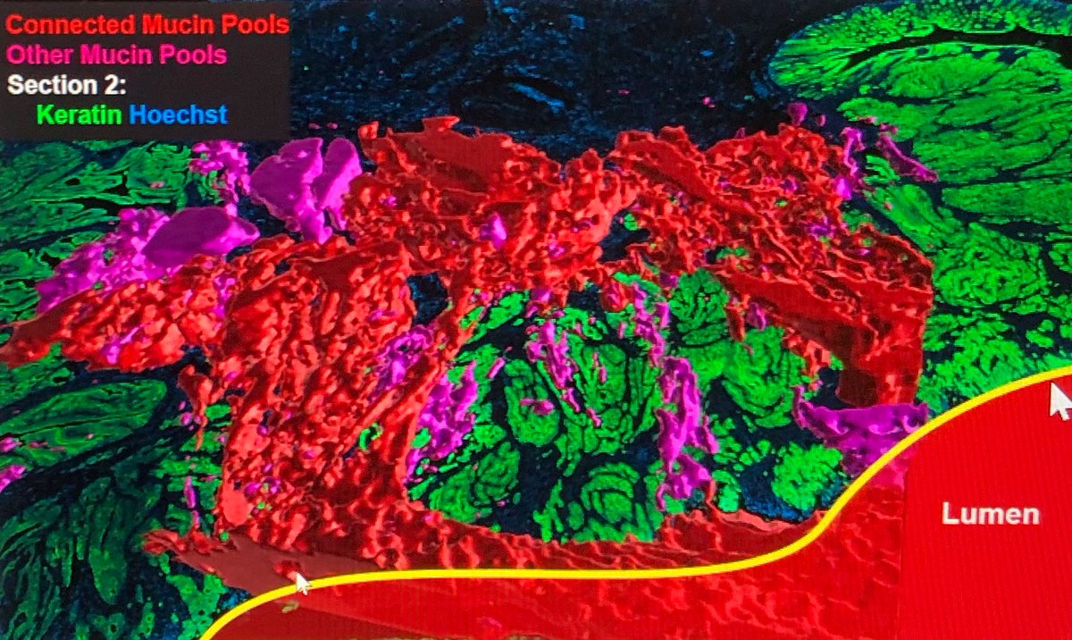 cemccarthy02's tweet photo. #CMSSHTAN: @SantagataLab is sharing mechanistic discoveries from a #ColorectalCancer atlas. #CancerMoonshotSeminar https://t.co/11A7AeCLsS