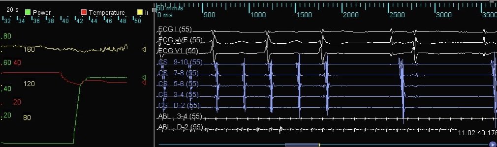 windycityep's tweet photo. Roof dependent LAFL terminated with 1 burn! #HDGrid showed flutter circuit looping around RPVs and LPVs with slow conduction on posterior wall and clear breakout on the roof. https://t.co/OtWHhCFqGU