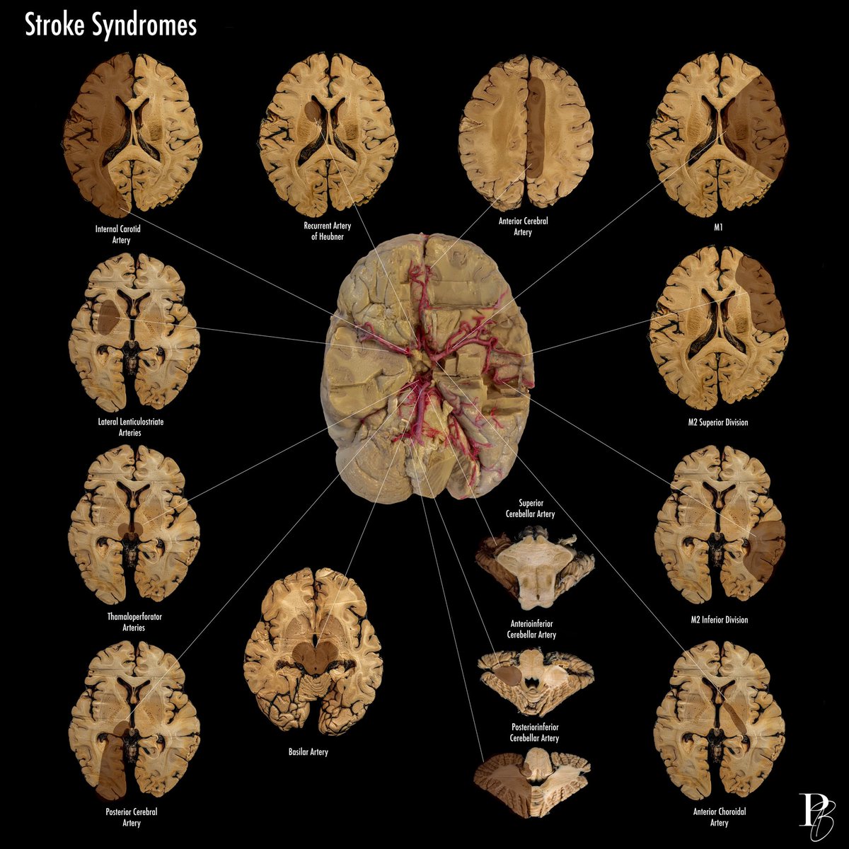 Photobrain project by <a href="/photobrain_mx/">Daniel “Photobrain” Ballesteros</a> displaying stroke syndromes.