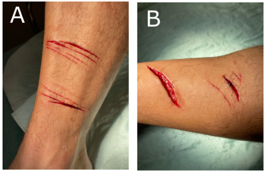 jem_journal's tweet photo. JEM Case of the week. 43 yo M zookeeper presents with a Komodo Dragon bite.  He presents to the ED asking if he needs an anti-venom.  What is your response and treatment?  Answer Thursday @aaeminfo #toxicology #MedTwitter https://t.co/MdrNt4JSv1
