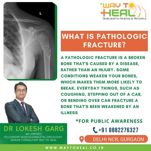 gutterloky's tweet photo. What is Pathologic Fracture?
For more information
visit the website https://t.co/Rj58bP0emb
Call @ 088822 76327 or Email us at waytoheal.mskonco@gmail.com
Way to HEAL
#waytoheal #Healthcare #drlokeshgarg #Musculoskeletaloncology #pathologicfracture #brokenbone #injury #coughing https://t.co/GCRZNlpFWv