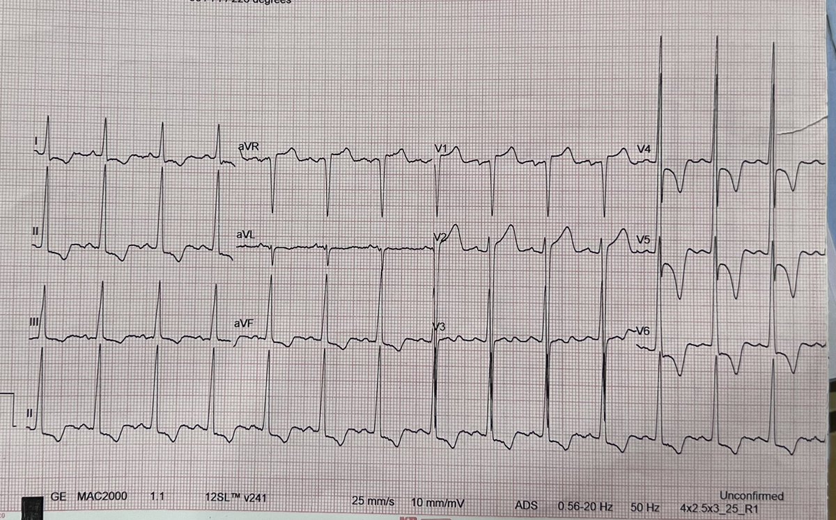 DrPrasadJain's tweet photo. A #classical case of hypertrophic #cardiomyopathy
Patient had blood pressure of 240/140 mmhg
#ECG -LVH with LV Strain
#2decho - concentric hypertrophy of LV. IVS and PW of 20 mm
#MedTwitter #Cardiology #electrocardiography #2decho https://t.co/OvvkkV05YU